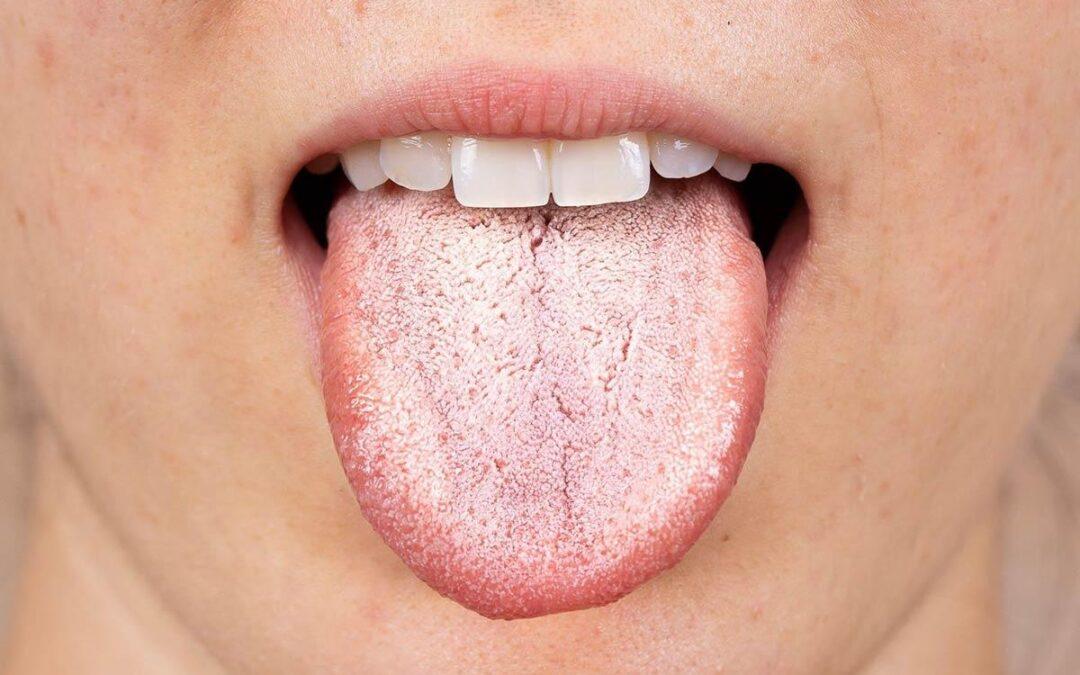 ¿Qué es la candidiasis oral?