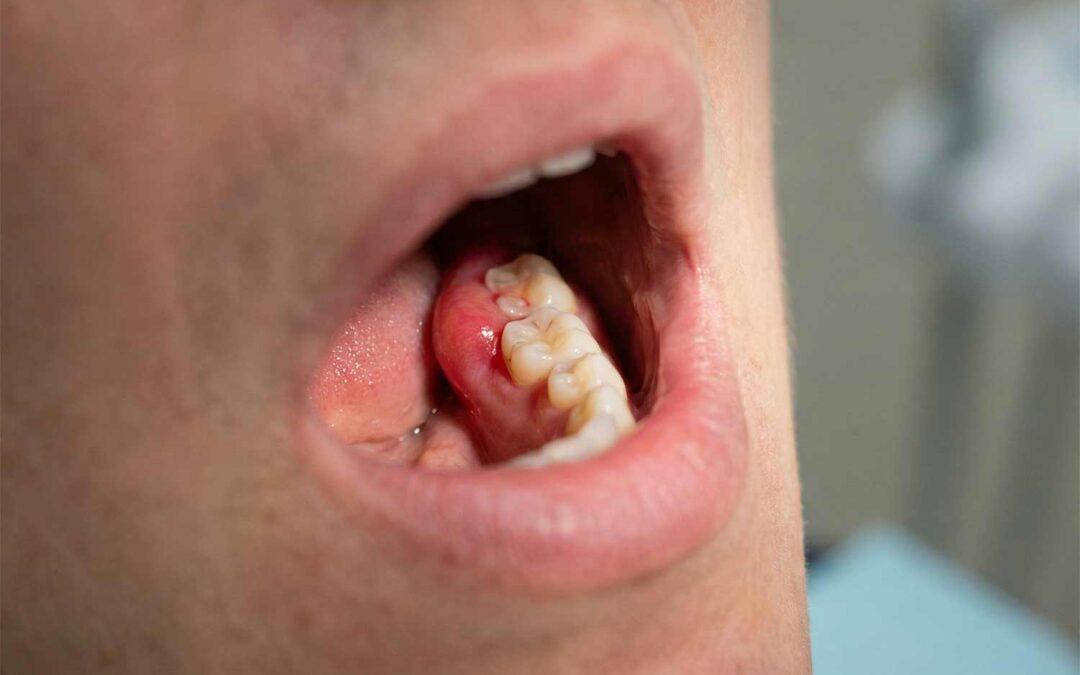 Qué hacer ante el dolor de la muela del juicio