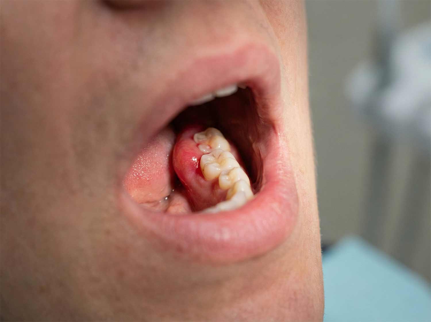 primer plano de una boca abierta que muestra la muela del juicio inflamada.