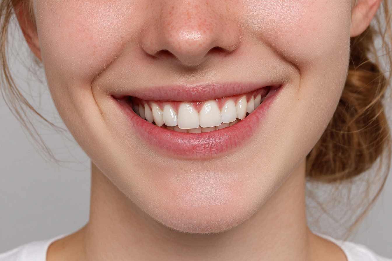 Primer plano de sonrisa con incisivos ligeramente apiñados antes de la ortodoncia.