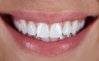 Carillas dentales en Logroño: cuándo son la mejor opción