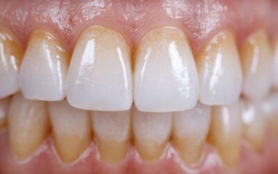 Fluorosis dental: manchas blancas en los dientes que no son caries