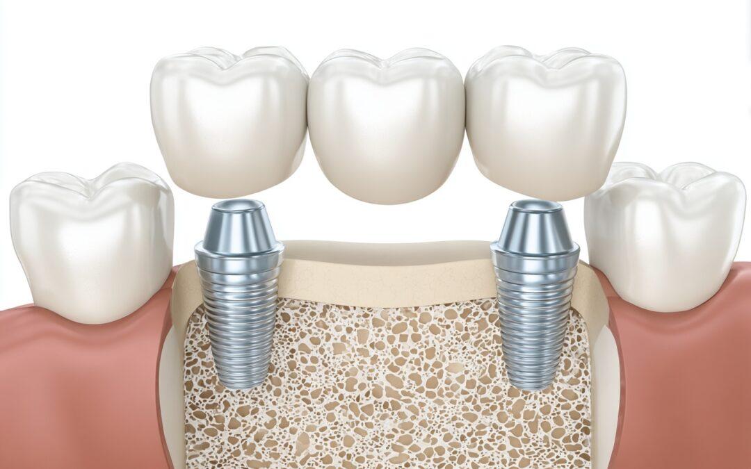 Implantes de carga inmediata en Logroño: qué son y cuándo se pueden poner