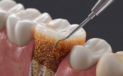 Periodoncia en Logroño: cómo tratar la enfermedad de las encías