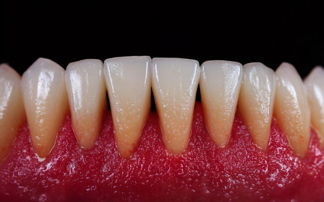 Recesión gingival: por qué se retrae la encía y qué hacer